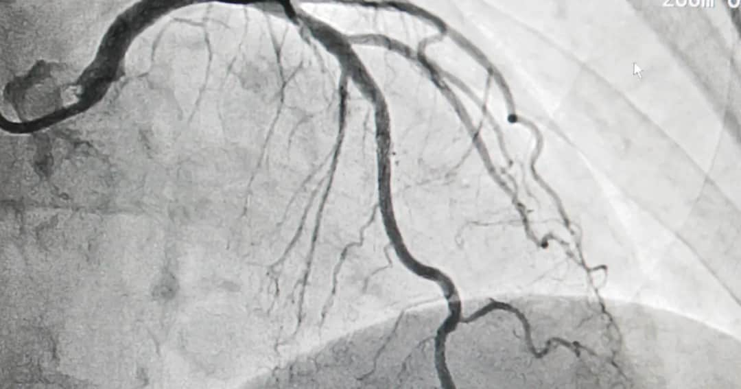 Koronografia - co to za badanie i jak może uratować Twoje serce