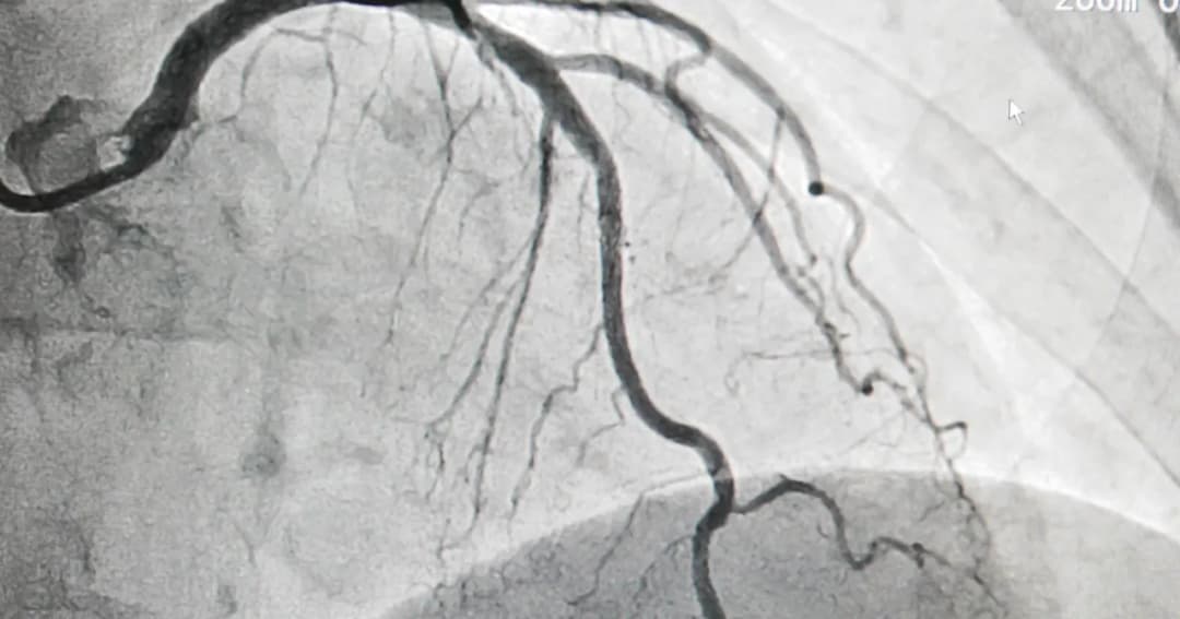 Koronografia - co to za badanie i jak może uratować Twoje serce