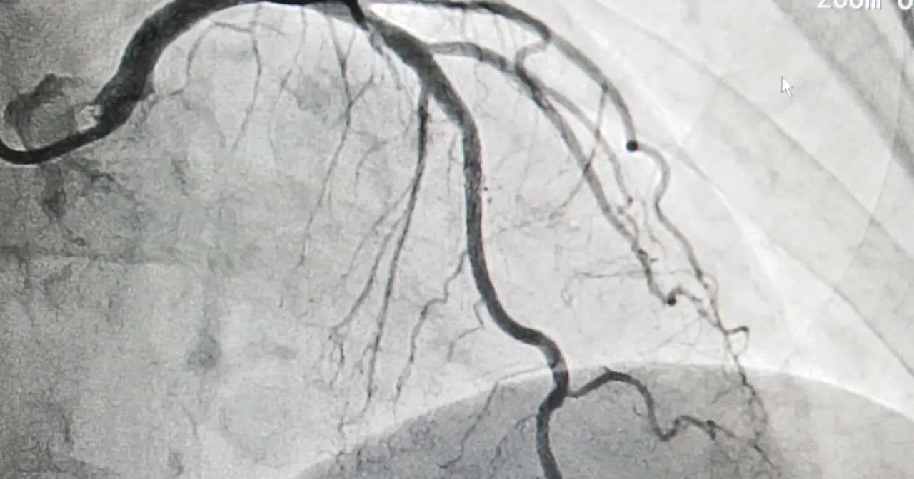 Koronografia - co to za badanie i jak może uratować Twoje serce