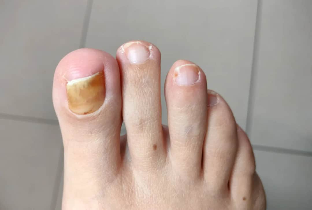 Grzybica stóp objawy: Jak rozpoznać i uniknąć poważnych problemów