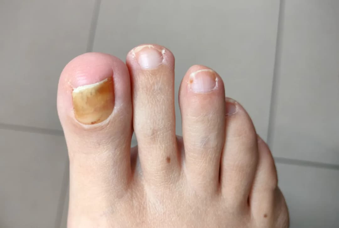 Grzybica stóp objawy: Jak rozpoznać i uniknąć poważnych problemów