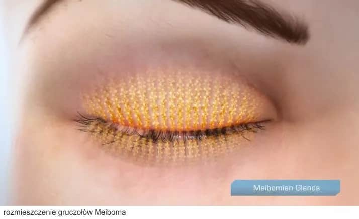 Zatkane gruczoły Meiboma objawy: jak je rozpoznać i leczyć?